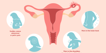 Ectopic Pregnancy: Causes, risks, and treatment