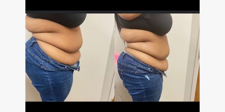 Is laser Lipo cavitation permanent?