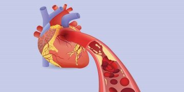 Heart Attacks and What Causes Them