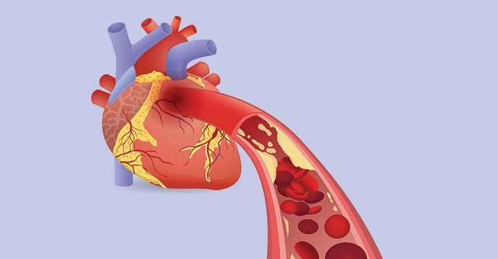 Heart Attacks and What Causes Them