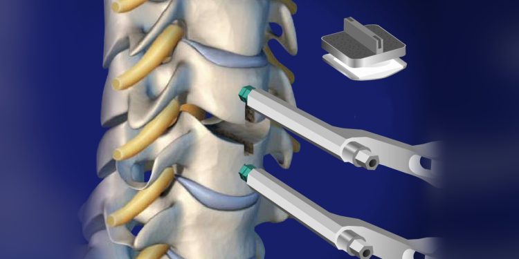 THE IMPORTANCE OF CERVICAL DISC REPLACEMENT