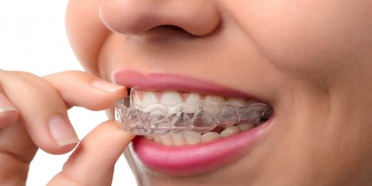 How Can Invisalign Help With Cavities?